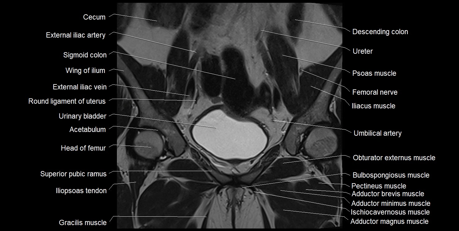 female pelvis coronal cross sectional anatomy image 13.webp